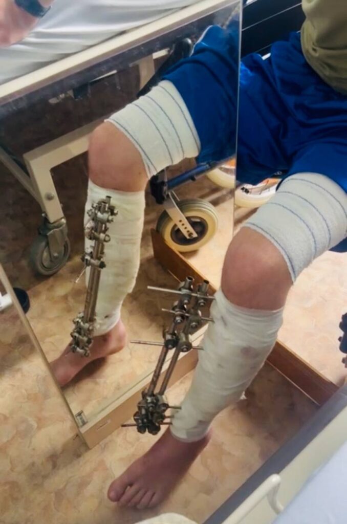 Дзеркальна терапія